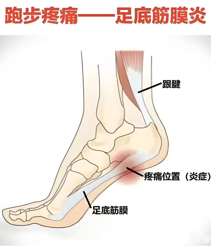足底筋膜炎如何自我康复_1_TBT-翟帅_来自小红书网页版.jpg