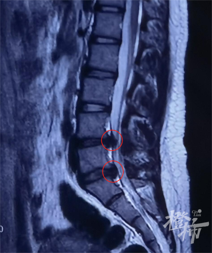 13岁女孩患腰椎间盘突出症，医生“复盘”发病原因，这两点要注意